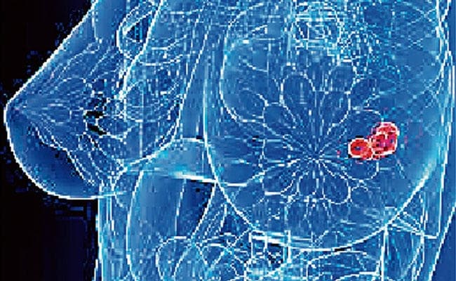 स्टैटिंस कम करता है स्तन कैंसर का खतरा