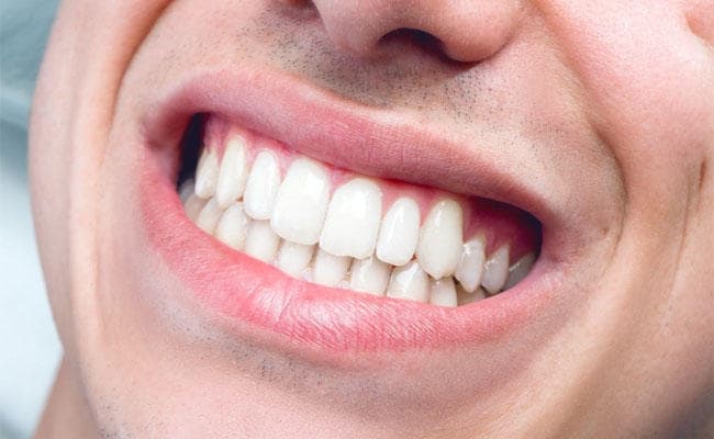 बेकिंग सोडा-नीबू पेस्ट से चमक उठेंगे दांत