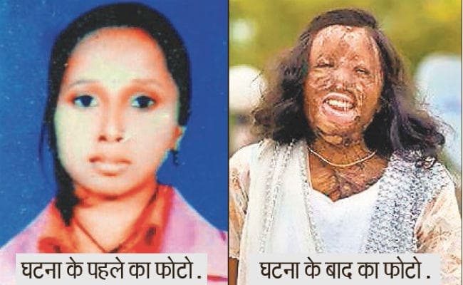 एसिड पीड़िता चंचल की हुई मौत, छोटी बहन ने कहा, मैं हार नहीं मानूंगी, लड़ती रहूंगी