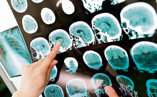 खान-पान सुधारें मल्टिपल स्क्लेरोसिस से बचें