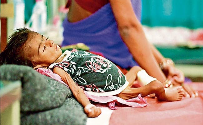 कुपोषण के मामले में झारखंड से बेहतर हैं बिहार और छत्तीसगढ़
