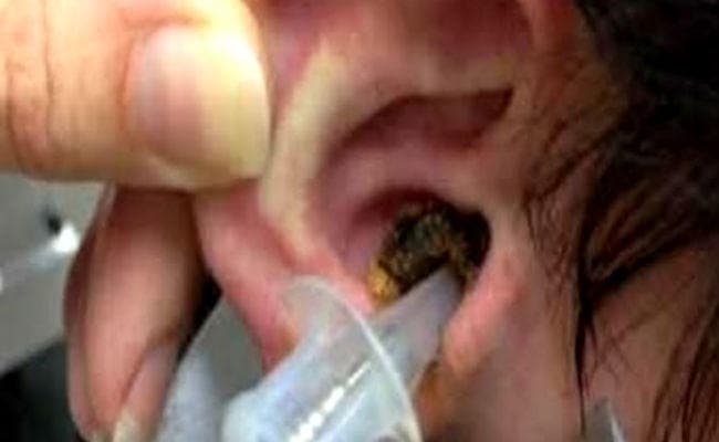 कान में 12 घंटे से घुसा था कीड़ा, दिमाग में घुसने की कर रहा था कोशिश, ऑपरेशन कर निकाला गया