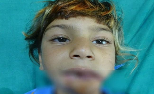 पाकिस्तान के डॉक्टर ने अफगानिस्तान की बच्ची का चेहरा बिगाड़ा, झारखंड के डॉक्टरों ने संवारा