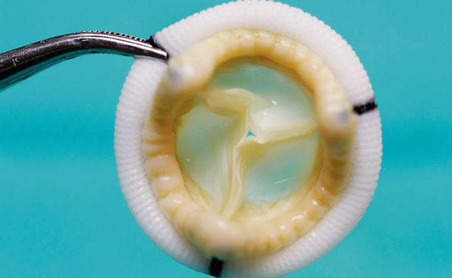 हृदय रोगियों के लिए टिश्यू वॉल्व ज्यादा बेहतर, जानें इसके फायदे