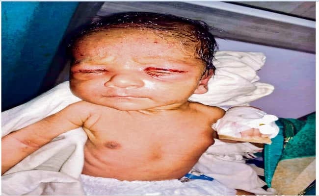 गोपालगंज सदर अस्पताल में बड़ी लापरवाही उजागर, एसएनसीयू में भर्ती नवजात को चींटियों ने काटा, हालत गंभीर