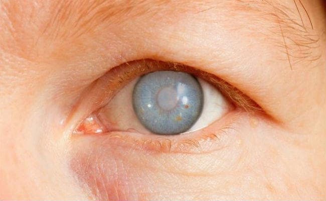 AIIMS Research: ग्लूकोमा मरीजों की आंखों में दबाव हो, तो मेडिटेशन दिलायेगा राहत