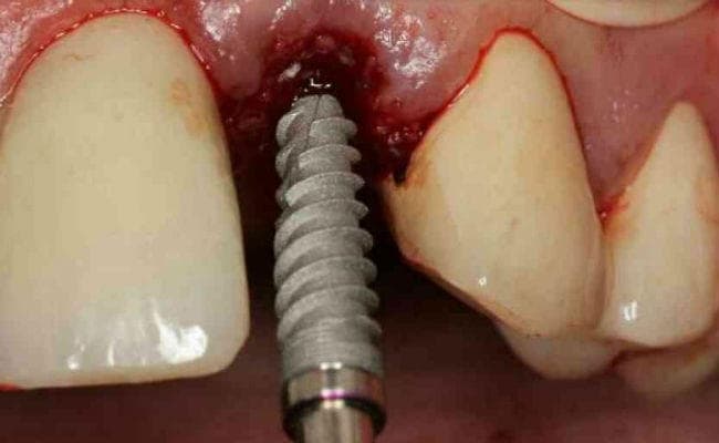 रांची : रिम्स के डेंटल कॉलेज में 30 रुपये में लगेगा कृत्रिम दांत, अगले साल से मिलेगी सुविधा