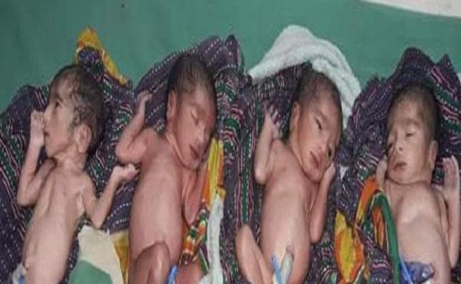 महिला ने चार बच्ची को एक साथ दिया जन्म, सभी स्वस्थ