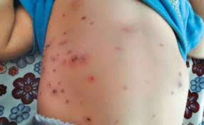 उल्टाडांगा में स्क्रब टाइफस से दो की मौत, कई बुखार से पीड़ित, निगम व स्वास्थ्य विभाग ने खोला हेल्थ कैंप