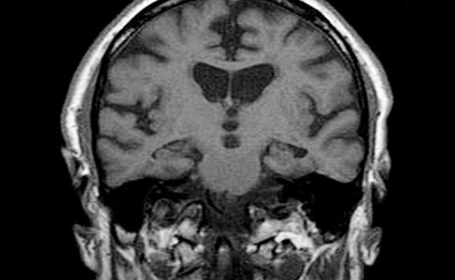 Dimentia : एमआरआई स्कैन से लगाया जा सकेगा जोखिम का पता
