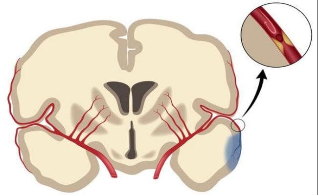 Health News: ब्रेन हैमरेज और स्ट्रोक का जोखिम काफी कम कर देगी यह दवा, जानें
