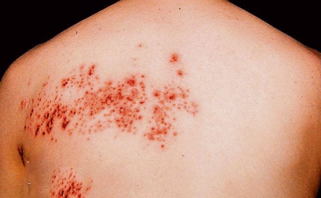 शहर में तेजी से फैल रहा हर्पीस जोस्टर, शरीर में हो रहे लाल दाने, जानें इसके लक्षण और उपाय