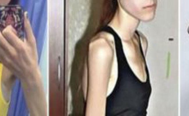 पटना : स्लिम बनने के चक्कर में बीमार हो रहीं छात्राएं, हेल्थ कैंप में 60% छात्राएं अनफिट