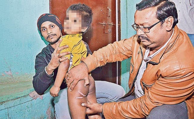जमशेदपुर : मां छोड़ कर चली गयी, पाल रही महिला ने चार साल के बच्चे को गर्म कलछुल से दागा
