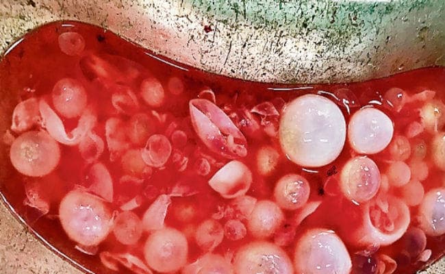 आइजीआइएमएस : रीढ़ की हड्डी में सिस्ट, बिहार में पहली बार सर्जरी से निकालाकी , बिहार में पहली बार सर्जरी से निकाला गया हड्डी में सिस्ट