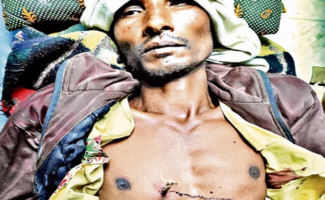 रांची : रिम्स के डॉक्टरों ने ऑपरेशन कर छाती से तीर को निकाला