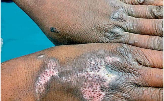 अत्याचार: दिल्ली में महिला डॉक्टर ने झारखंड की बच्ची के हाथ जलाये, गर्म पानी फेंका