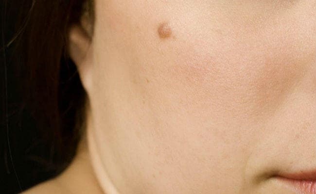 अनचाहे तिल को हटाना है तो करें यह घरेलू उपाय, लहसुन है कारगार