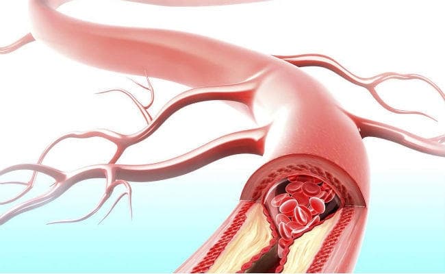 Health Matters : लंबे समय से रखा हुआ खून ऐसे मरीजों के लिए हो सकता है नुकसानदेह