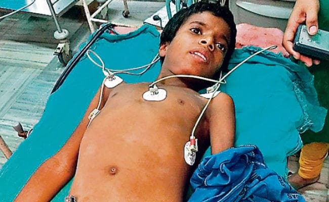 झारखंड : बच्चे के फेफड़े में फंसा था इमली का बीज, रिम्स के डॉक्टरों ने ऑपरेशन कर निकाला