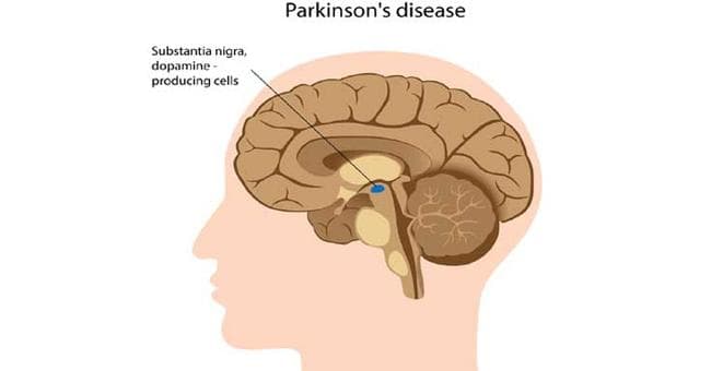 पार्किंसन : इस बीमारी के खिलाफ हमदर्दों का साथ जरूरी, जानें कैसे होता है यह रोग