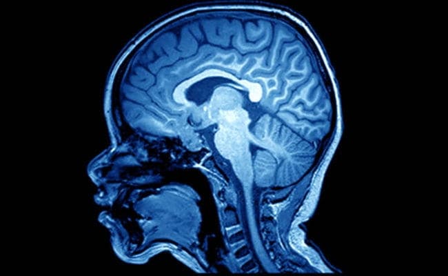 मस्तिष्क स्कैन दिमागी और मानसिक विकृति का पता लगाने में कर सकता है मदद
