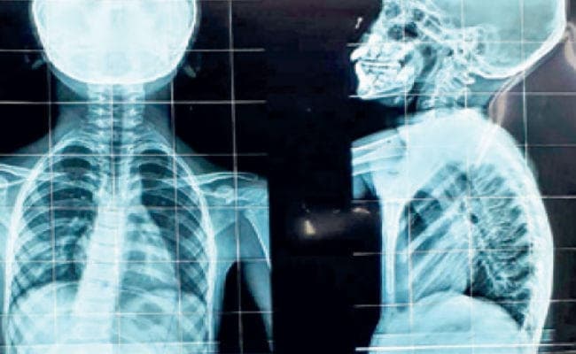 पश्चिम बंगाल : तेजी से बढ़ रहा हैं स्कोलियोसिस, किशोरावस्था में ज्यादा होता है, जानिए इसके बारे में