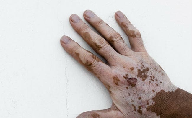 विश्व विटिलिगो दिवस पर विशेष: ठीक हो सकता है सफेद दाग, छिपायें नहीं, जानें लक्षण
