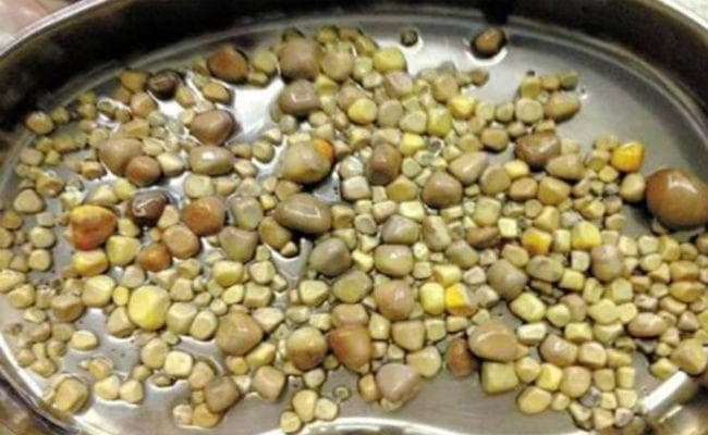 OMG: 45 साल के आदमी की किडनी से डॉक्टरों ने निकाले 856 स्टोन!