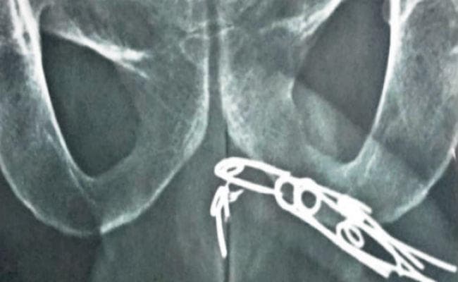 डॉक्टरों ने सर्जरी कर मरीज की मूत्रनली से निकाली आलपीन