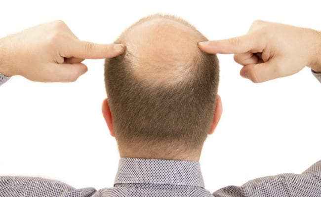 ...अब मिलेगी गंजेपन से आजादी, IIT के वैज्ञानिकों ने इलाज के लिए विकसित किया हाइड्रोजेल