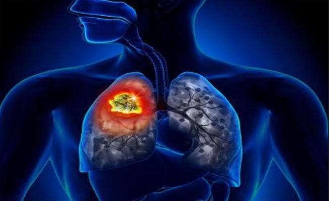 Health Research: धूम्रपान नहीं करनेवाले भी फेफड़े के कैंसर से हैं पीड़ित, जानें वजह...