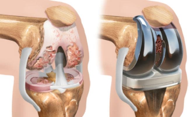 घुटना प्रतिरोपण के लिए अधिकतम मूल्य पूर्व के स्तर पर बरकरार, जानें