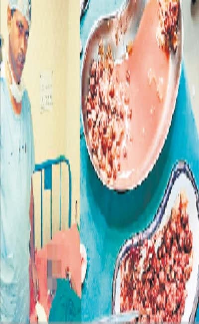 बच्चे के पेट से निकले बेर, खजूर के 203 बीज