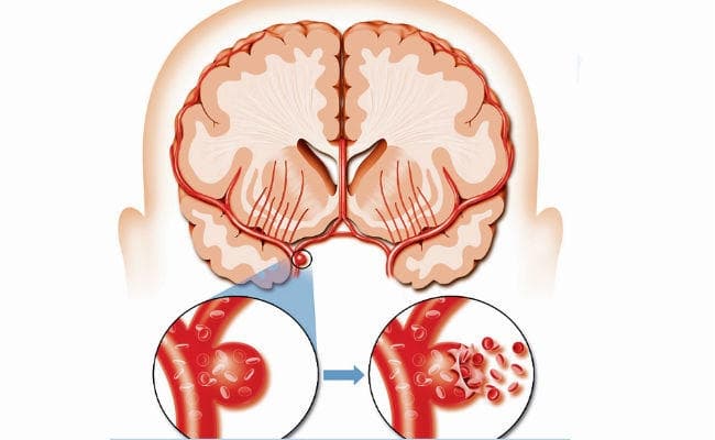ब्रेन स्ट्रोक का सबसे बड़ा रिस्क फैक्टर है हाइ बीपी, जानें अटैक आने पर क्या करें