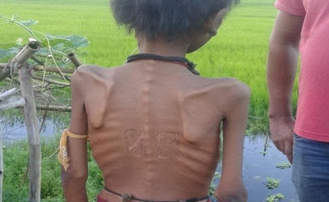 कुपोषित बच्चे के इलाज को लिए मांगे 500 रुपये, तस्वीर वायरल हुई तो…