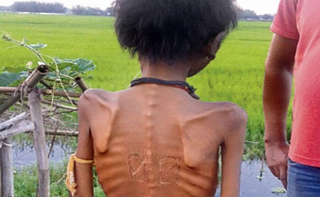 पूर्णिया : कुपोषित के इलाज को मांगे 500 रुपये