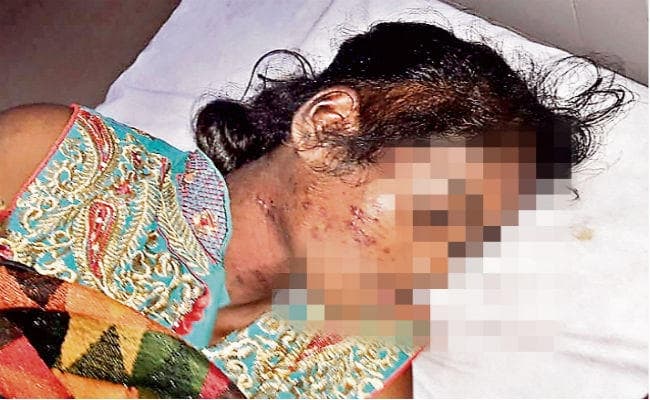 हजारीबाग : दो सौ रुपये चुराने के आरोप में जब साहेब और उनकी पत्नी ने नौकरानी को इस्तिरी से दागा