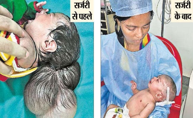 निजी अस्पतालों ने किया इलाज से इनकार, रिम्स ने जटिल सर्जरी कर एक माह के बच्चे को दी नयी जिंदगी