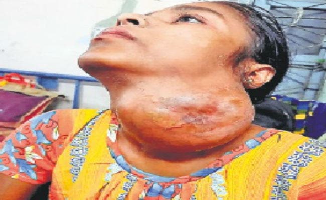 गले से निकाला एक किलो का ट्यूमर