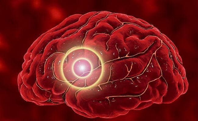 वर्ल्ड स्ट्रोक डे आज : समय रहते उपचार से बच सकती है जान