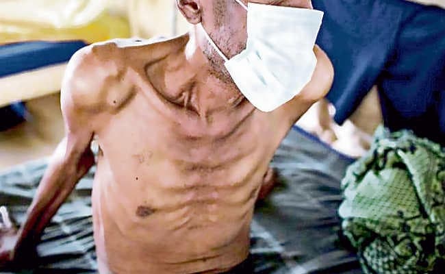 बढ़ रही है टीबी मरीजों की संख्या, 2367 एमडीआर टीबी मरीज मिले जिसमें 59 फीसदी मरीज ही करा रहे हैं इलाज