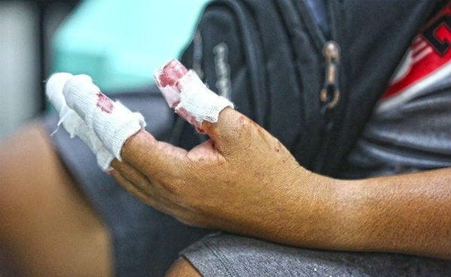 पटाखा जलाने में किशोर की चार अंगुलियां नष्ट