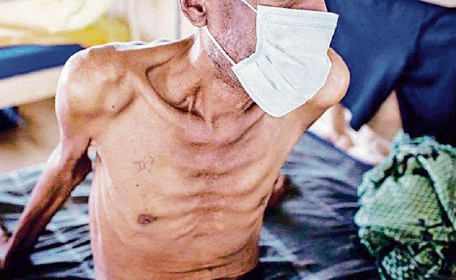 पटना : 14 जिलों के प्राइवेट अस्पतालों में ढूंढ़े जायेंगे 80 हजार टीबी मरीज