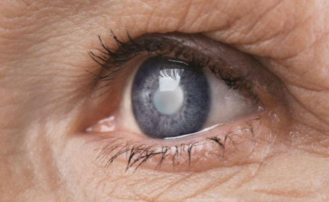 मोतियाबिंद के ऑपरेशन के बाद भी 600 लोगों के आंखों की समस्या नहीं हुई दूर, सबसे अधिक शिकायत धनबाद से