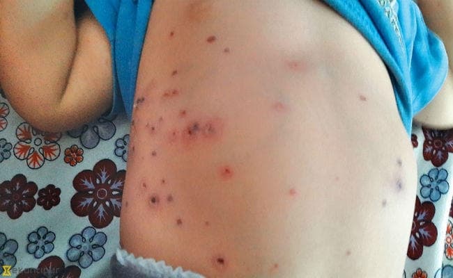 स्क्रब टाइफस का बढ़ रहा खतरा, दो मरे