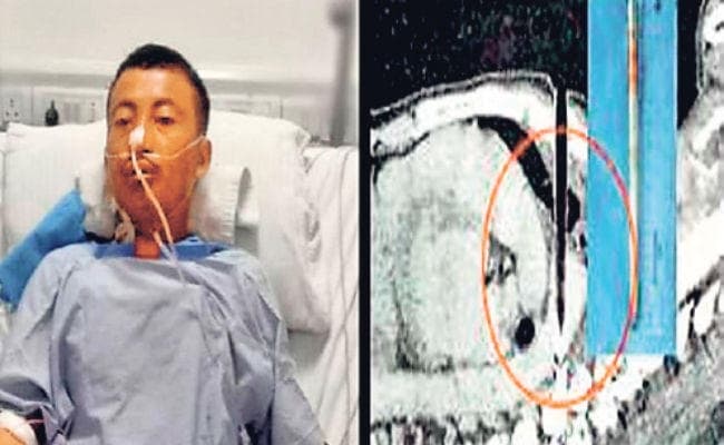 कोलकाता : शरीर से तीर निकालने के लिए दुर्लभ ऑपरेशन