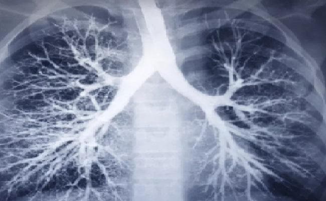 फेफड़े की गंभीर बीमारी से बचा सकता है विटामिन डी