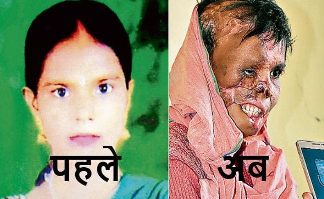 बेटा नहीं हुआ, तो पति ने चेहरे पर फेंक दिया तेजाब, दर्द भरी दास्तां सुनाते हुए रो पड़ीं पलामू निवासी रिंकू देवी