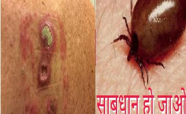 मिजोरम में 150 लोग स्क्रब टाइफस बीमारी से पीड़ित पाए गए